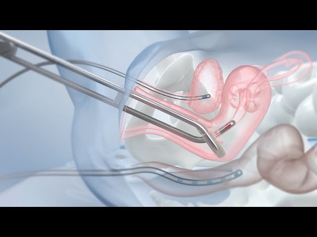 Cancer Treatment with Brachytherapy - Radiation