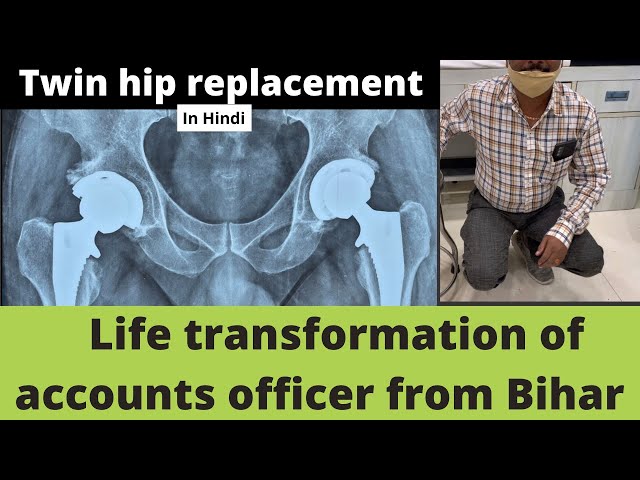 Recovery in Double hip replacement-How long does it take?दोनों कूल्हों के रिप्लेसमेंट के बाद रिकवरी