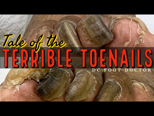 Tale of the Terrible Toenails: Trimming Long Fungal Toenails (This Tale Has a Happy Ending)