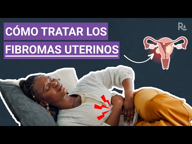 Fibromas uterinos: ¿Cuáles son los síntomas y las opciones de tratamiento?