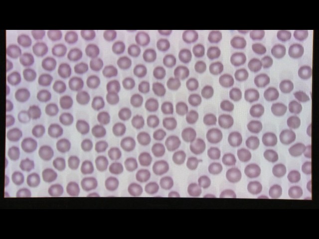 Blood Smear Evaluation