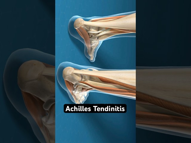 How Surgeons Repair a Worn-Out Achilles Tendon