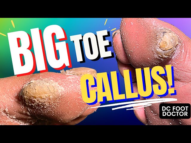 Big Toe Callus