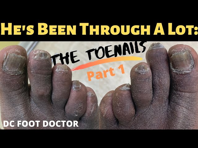 Trimming of Fungal Toenails: He's Been Through A Lot (The Toenails)