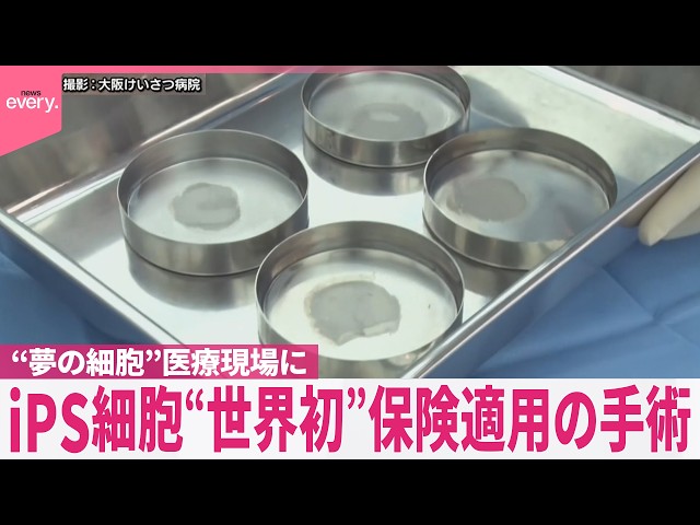 【iPS細胞】“世界初”保険適用の手術  “夢の細胞”ついに医療現場に  iPS細胞の実用化…今後は？