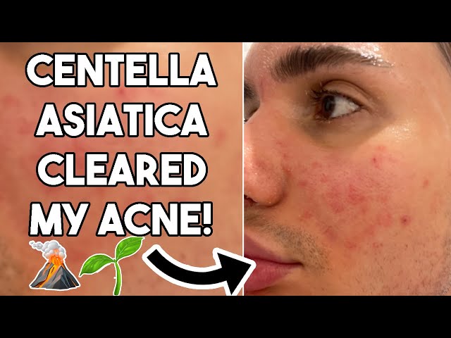 Centella Asiatica will CLEAR your ACNE! |🌱| Best products containing Centella!