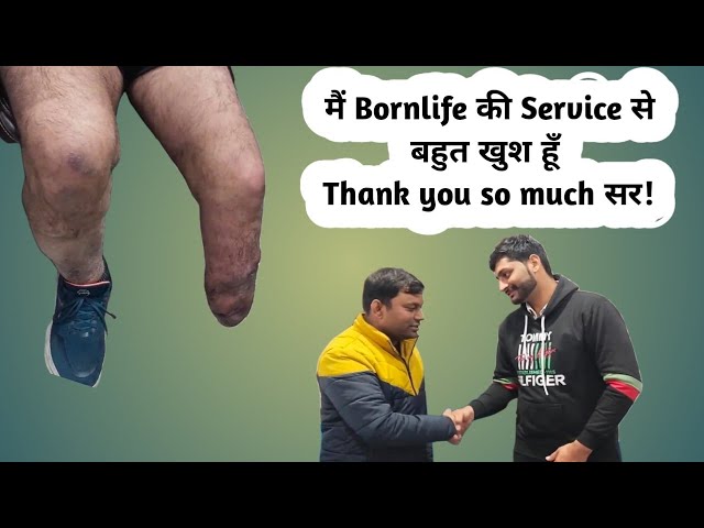 Below Knee Prosthetic Leg With High Activity Carbon Foot.