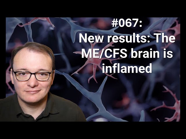 067 - New results: The ME/CFS brain is inflamed