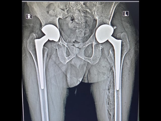 Total Hip Replacement & Partial Knee replacement -Live Q&A with Dr Pankaj Walecha 25.01.2026