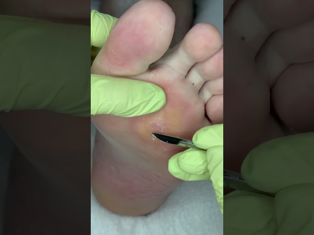 Callus Removal Process🫠🔊