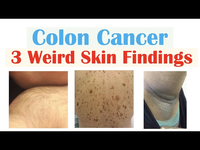 3 Weird Signs of Colon Cancer (Found on the Skin)
