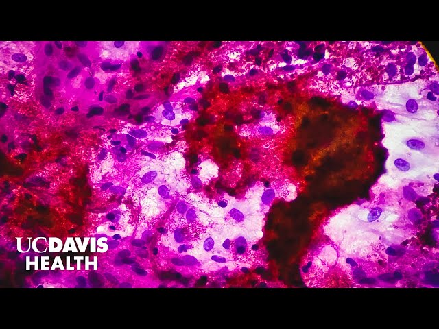 New Blood Test for Tuberculosis Could Transform Global TB Diagnosis | UC Davis Health Research