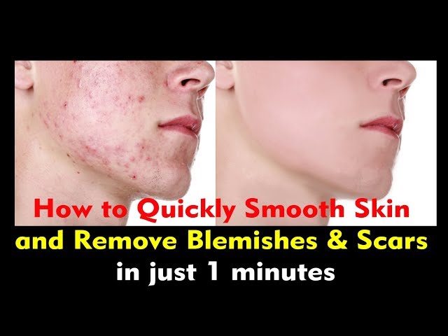 How to Quickly Smooth Skin and Remove Blemishes & Scars in just 1 minutes!! BUT2WHY