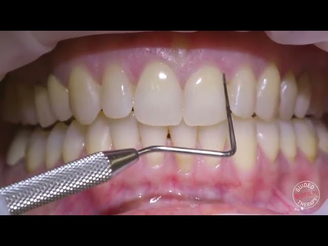 teeth cleaning تنظيف الأسنان