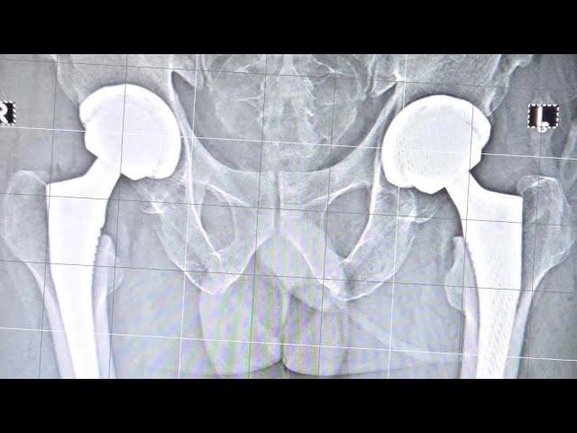 Direct Anterior THR with Hip Navigation- Live show with Q&A 26.04.2026