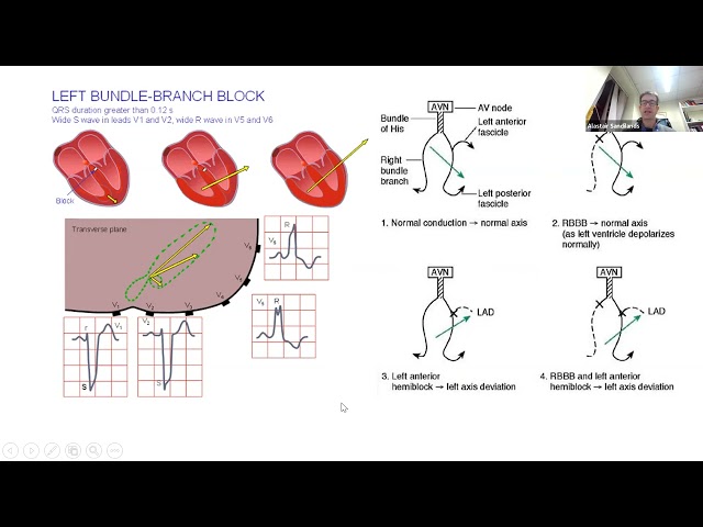 ECG; Broad Complex Tachycardias