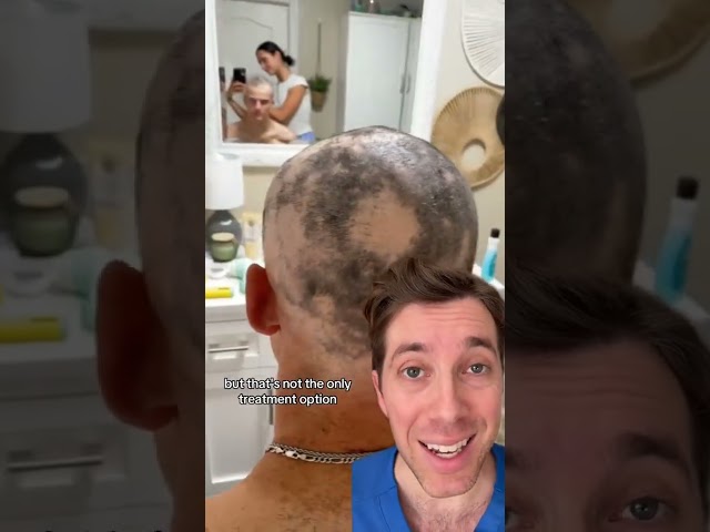 Emotional Impact Living with Alopecia Areata