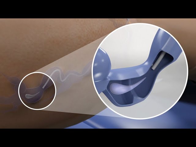 Glue Treatment for Varicose Veins (3D Animation)