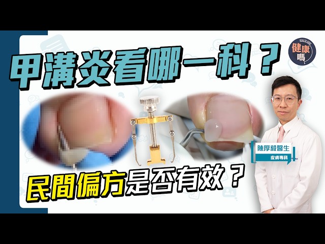 甲溝炎看哪一科？｜修甲神醫？網購神器？皮膚科醫生評測民間偏方！｜健康嗎@HealthCode【Chat醫D】 #指甲 ＃皮膚科 ＃甲溝炎