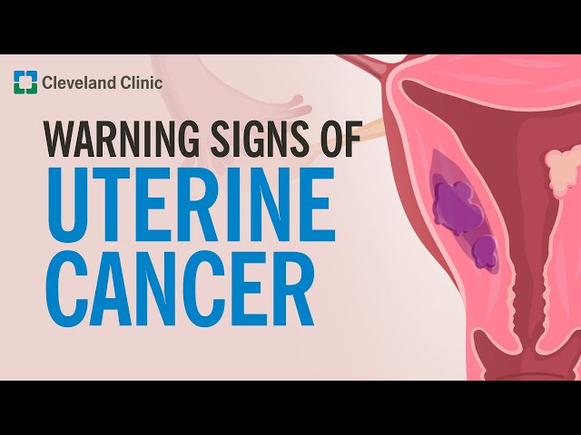 The Most Common Warning Sign of Uterine Cancer