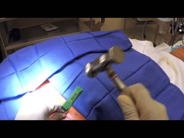 R3 Stem Cell Training Video - Bone Marrow Harvest Procedure (844) GET-STEM