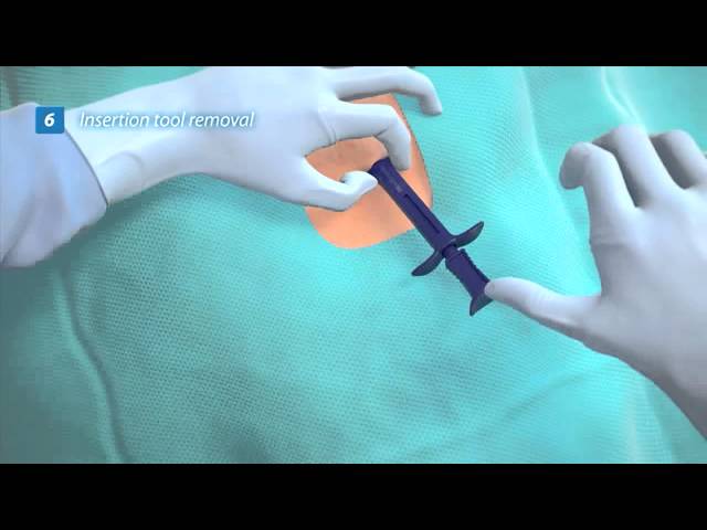Reveal LINQ Insertion Animation
