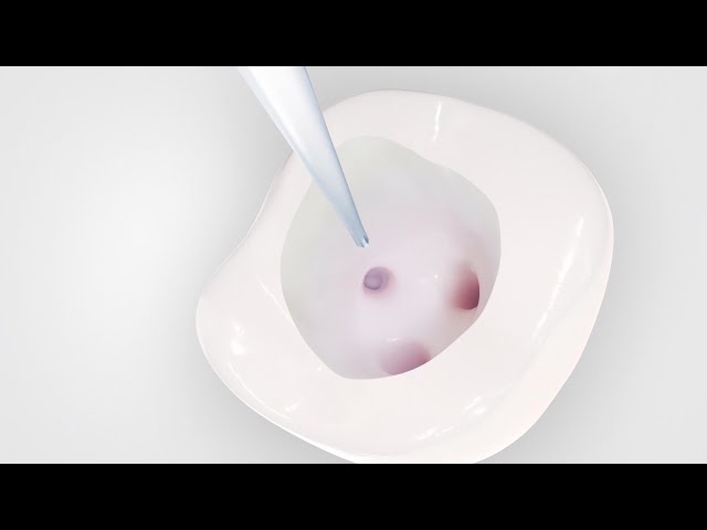 Root Canal Treatment / Cleaning | Dental Animation