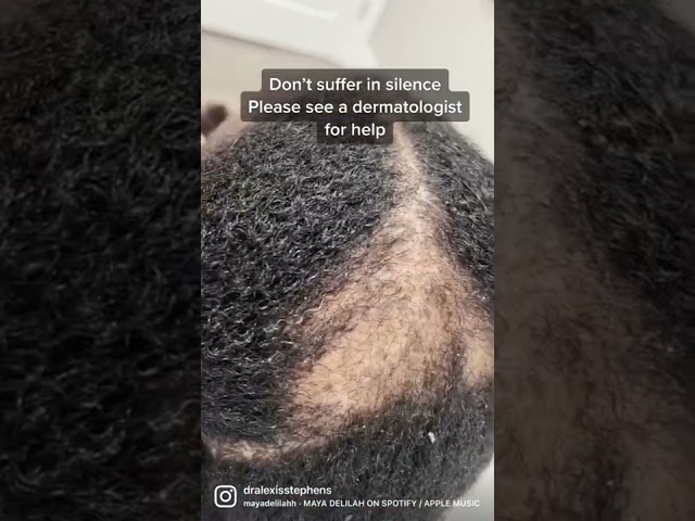Hair loss/ Alopecia Help