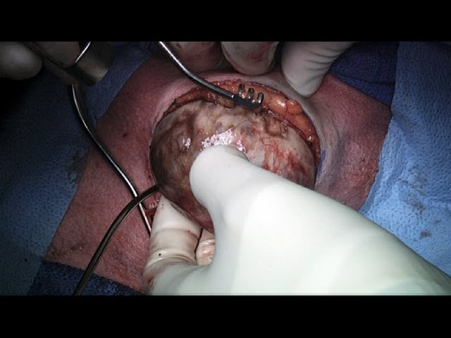 Thyroid Surgery & Its Risks / Complications (Thyroidectomy) (GRAPHIC)