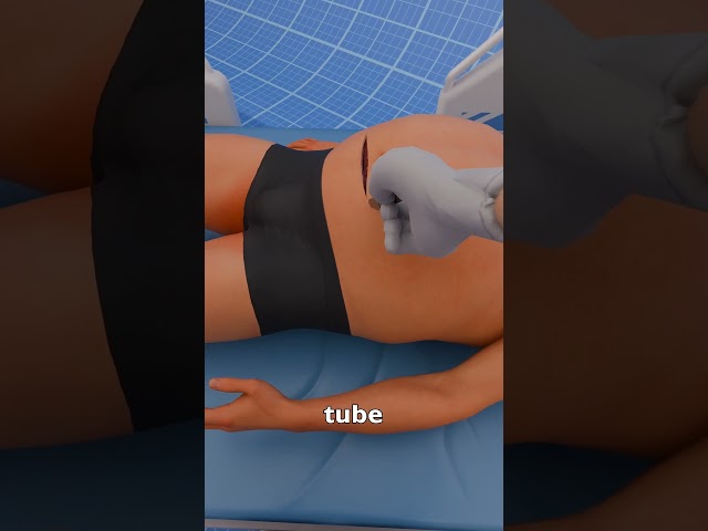 How Liposuction Works 🤔