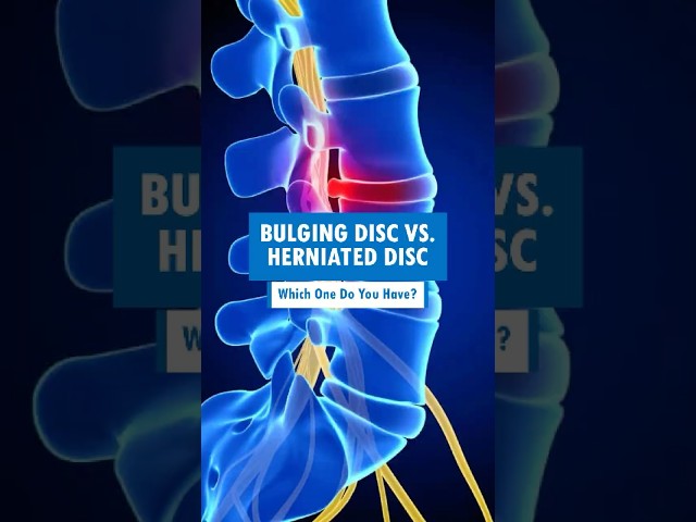 Bulging vs. Herniated Disc #shorts