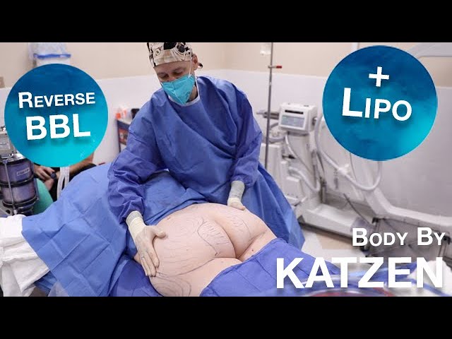 Reverse BBL plus Liposuction of the Mons and Thighs
