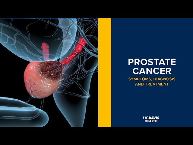 Prostate Cancer - Symptoms, Diagnosis and Treatment Explained | UC Davis Health
