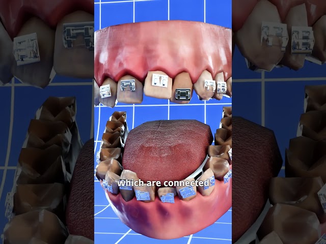 How Braces Work ๐ค