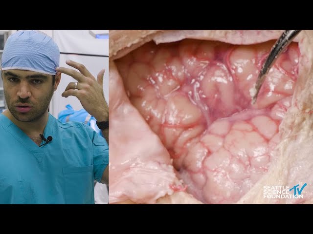 Orbitozygomatic Approach - Demonstration and Key Anatomy - Matias Costa, M.D.