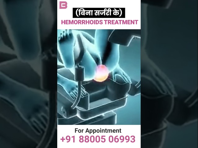 Hemorrhoids Treatment Without Surgery #piles #bawasirkailaj #hemorrhoids