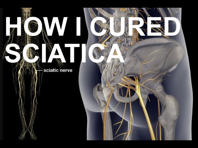 How I Cured Sciatica | BLACKBELTSECRETS