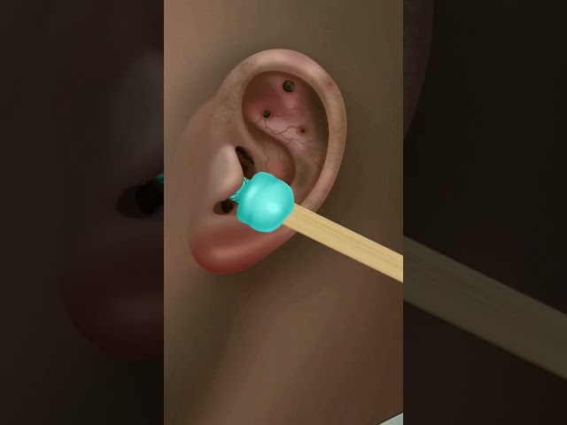 ear treatment 😮💥 #shorts #asmr #treatment #viral